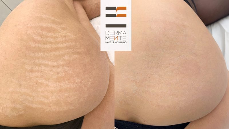 Dermopigmentazione paramedicale areola Roma - Dermamente