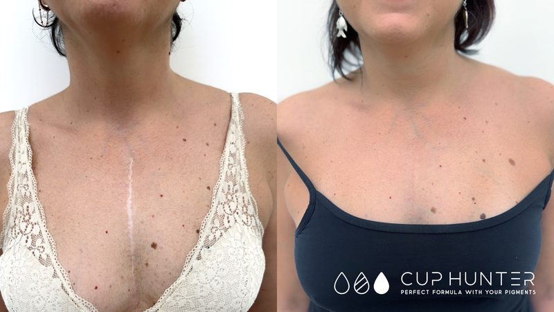 Coprire cicatrici seno con dermopigmentazione Roma — risultato camouflage