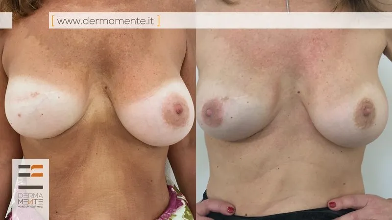 Camouflage smagliature Roma dermopigmentazione paramedicale risultato