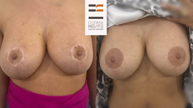 Copertura cicatrici con dermopigmentazione Roma