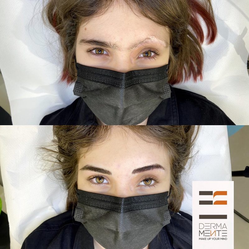 Copertura cicatrici chirurgiche dermopigmentazione Roma — prima e dopo Ennio Orsini