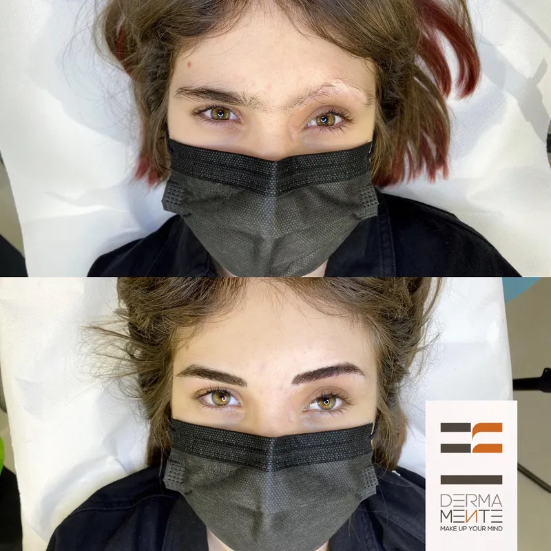 Copertura cicatrici e smagliature Roma dermopigmentazione - prima e dopo