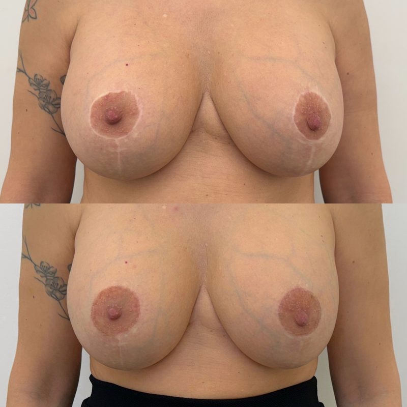 Dermopigmentazione correttiva Roma