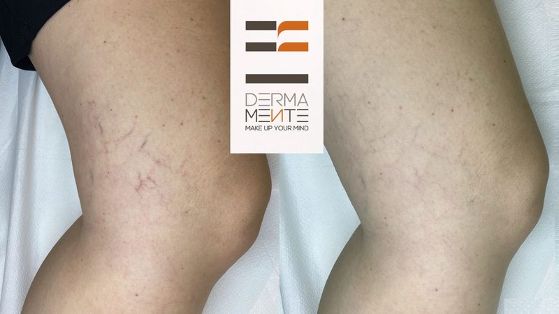 Dermopigmentazione paramedicale prima e dopo Roma