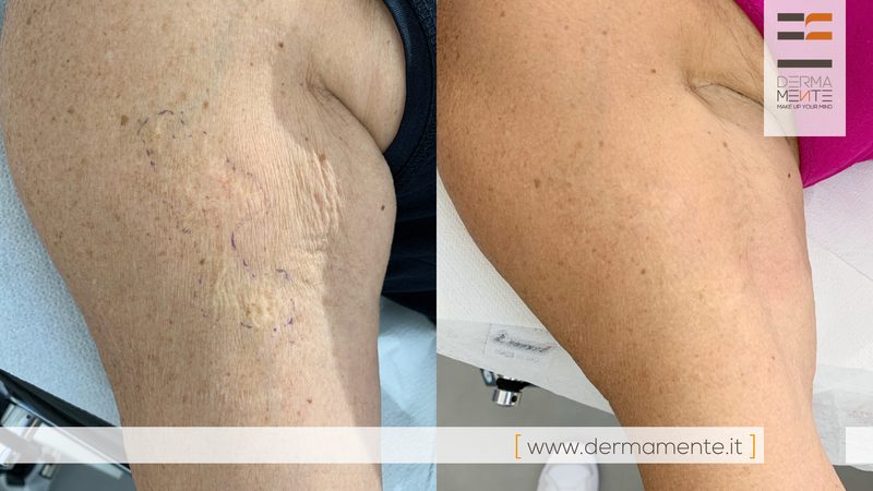 Dermopigmentazione paramedicale prima e dopo Roma