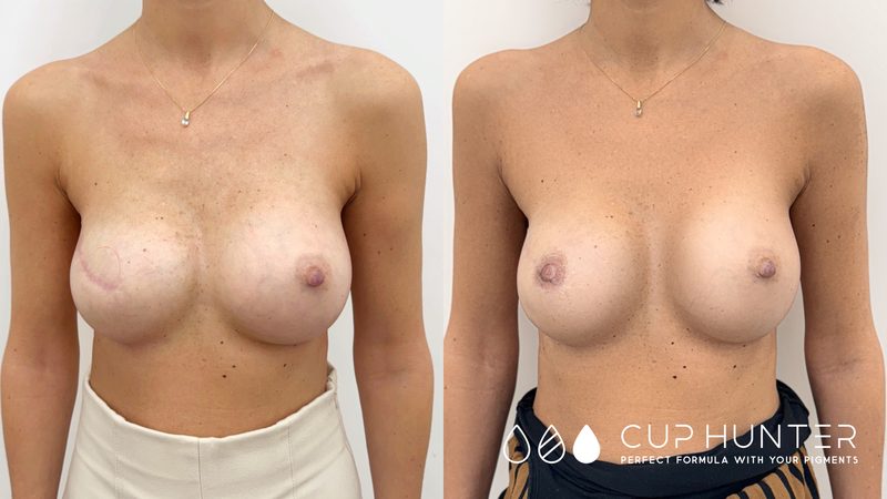 Ricostruzione areola dopo mastectomia Roma