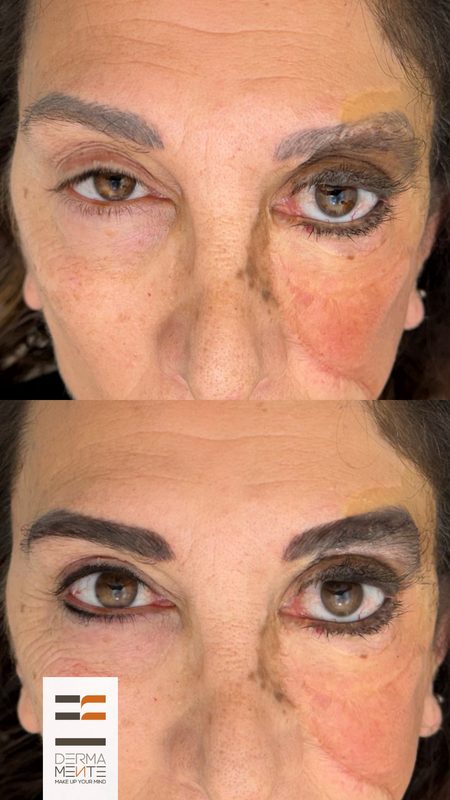 Ricostruzione areola dopo mastectomia Roma