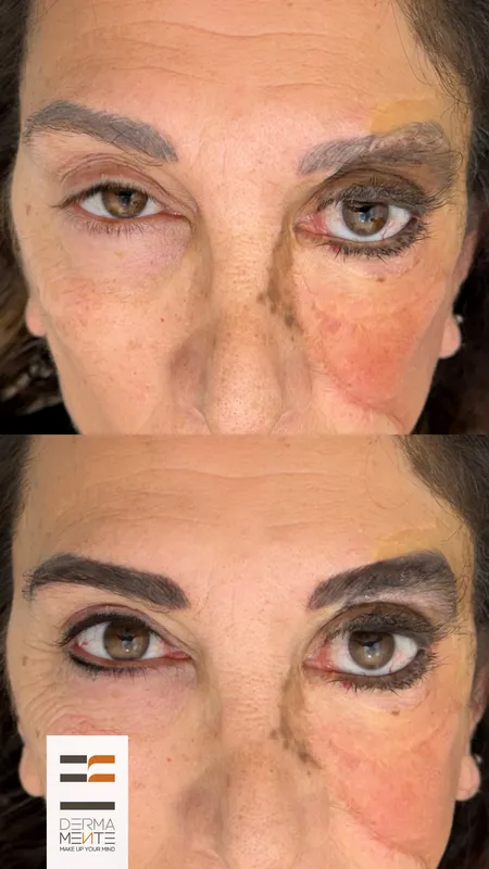 Ricostruzione areola dopo mastectomia Roma - tatuaggio medicale