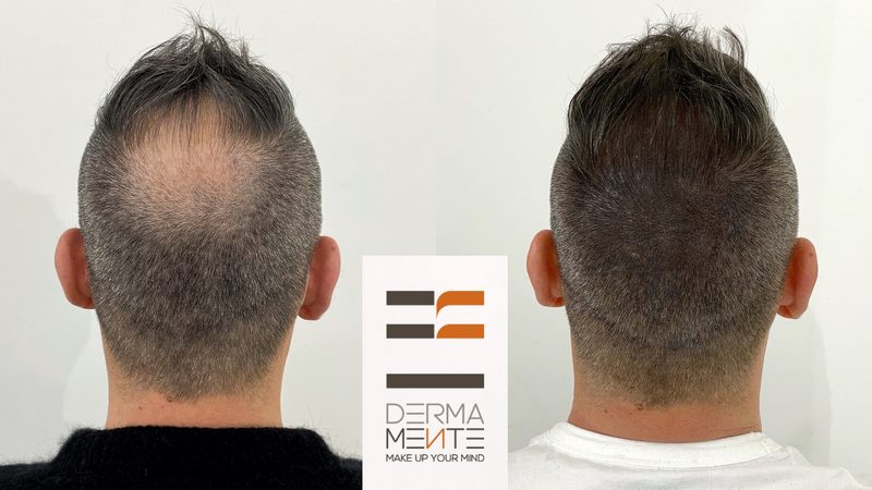 Infoltimento capelli tricopigmentazione Roma