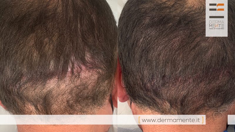 Infoltimento capelli tricopigmentazione Roma