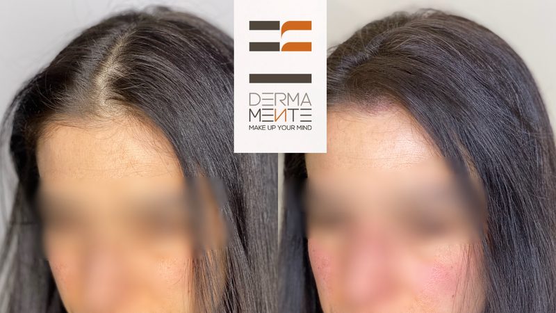 Infoltimento capelli tricopigmentazione Roma