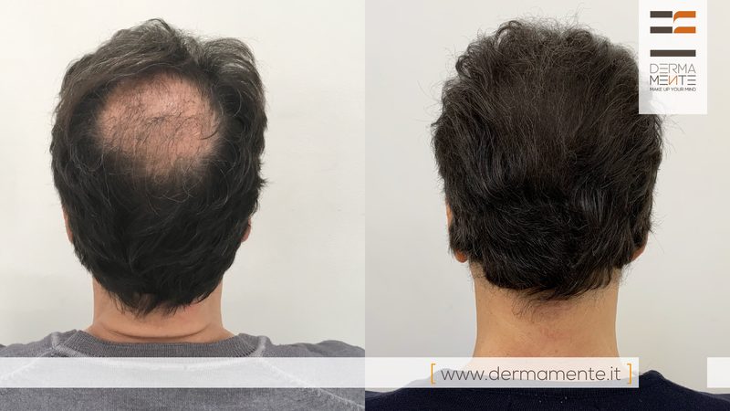 Micropigmentazione cuoio capelluto Roma