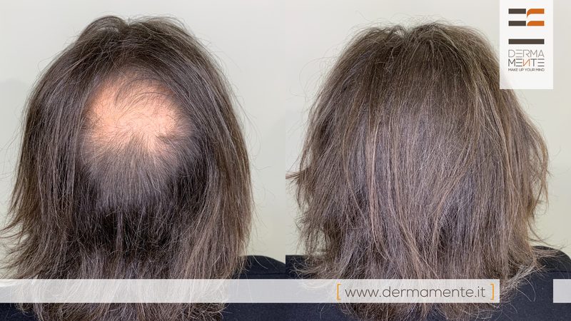 Micropigmentazione cuoio capelluto Roma