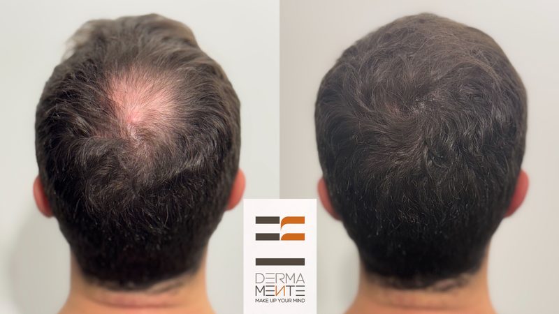 Scalp micropigmentation Roma