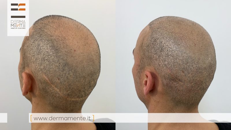 Tricopigmentazione alopecia Roma