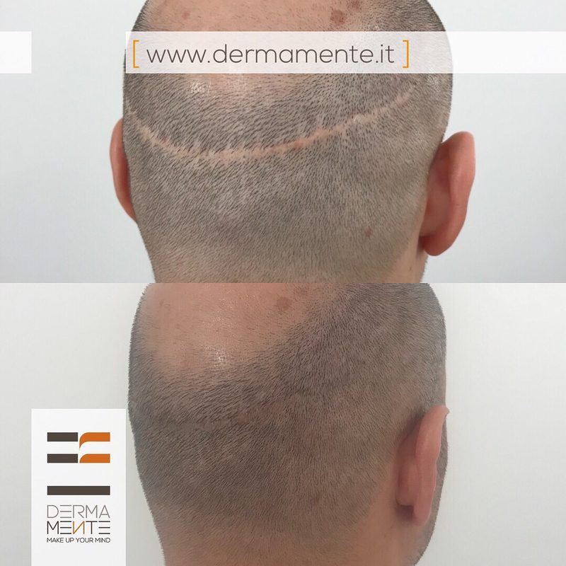 Tricopigmentazione alopecia Roma