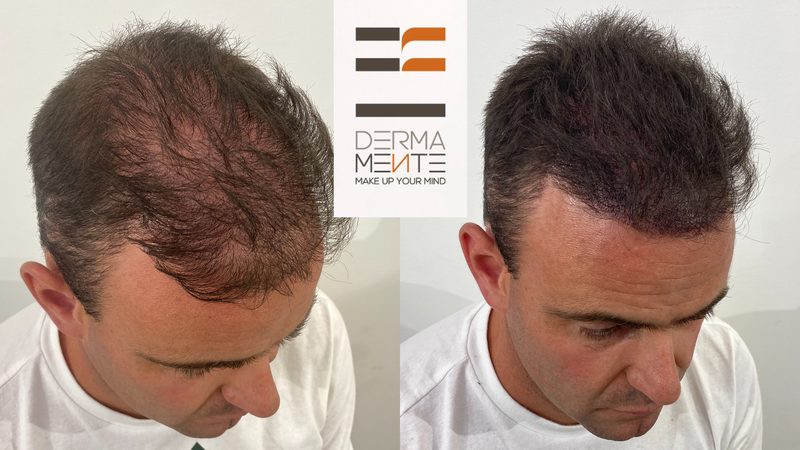 Tricopigmentazione alopecia Roma