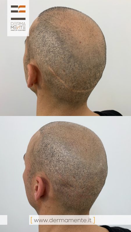 Tricopigmentazione calvizie Roma