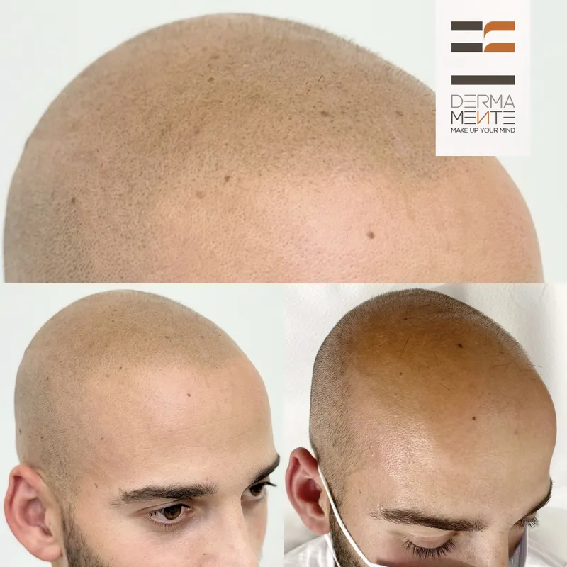 Tricopigmentazione calvizie Roma - effetto rasato risultato naturale