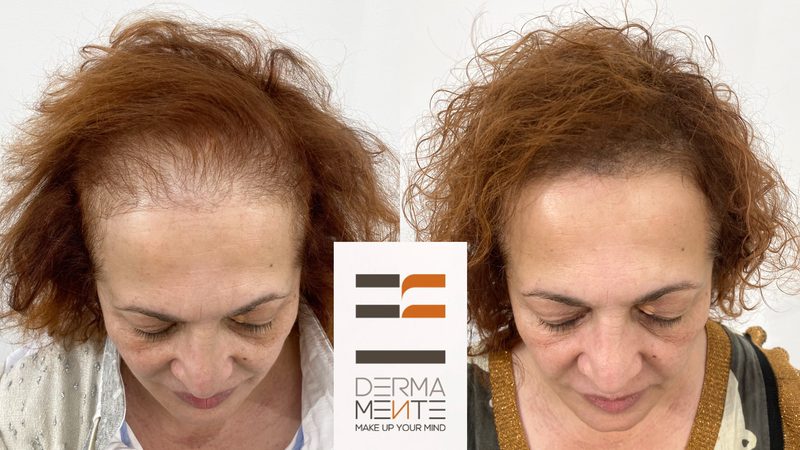 Tricopigmentazione cicatrice trapianto Roma