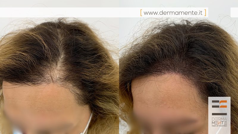 Tricopigmentazione cicatrice trapianto Roma