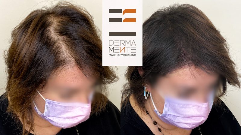 Tricopigmentazione cicatrice trapianto Roma