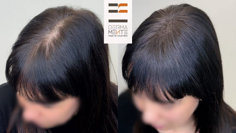 Tricopigmentazione donna Roma