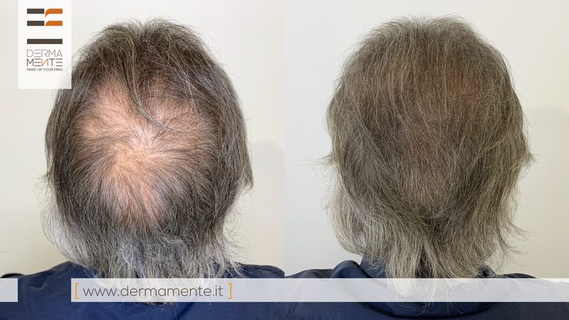 Tricopigmentazione effetto densità Roma