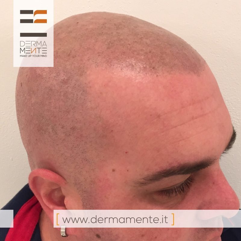 Tricopigmentazione effetto densità Roma