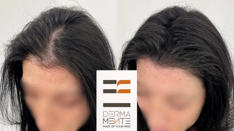 Tricopigmentazione effetto densità Roma - capelli tatuati infoltimento