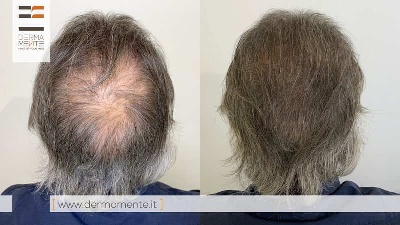 Tricopigmentazione effetto rasato Roma