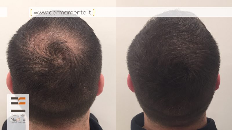 Tricopigmentazione effetto rasato Roma