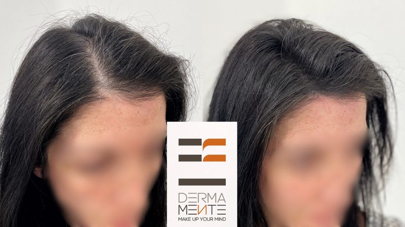 Tricopigmentazione effetto rasato Roma