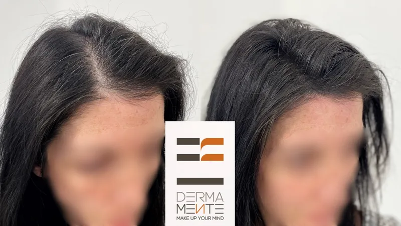 Effetto rasato Roma tricopigmentazione - prima e dopo calvizie avanzata