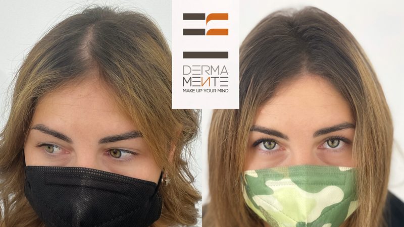 Tricopigmentazione risultato prima e dopo Roma