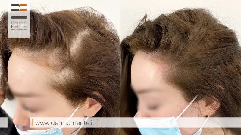 Tricopigmentazione prima e dopo Roma - micropigmentazione cuoio capelluto