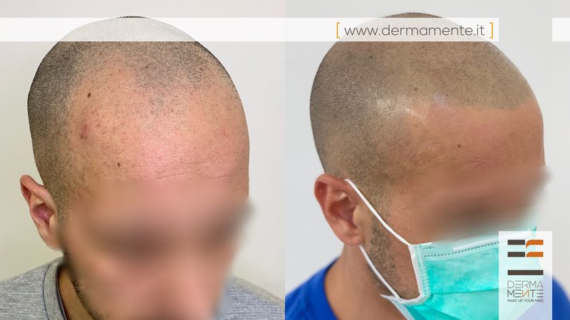 Tricopigmentazione risultati Roma