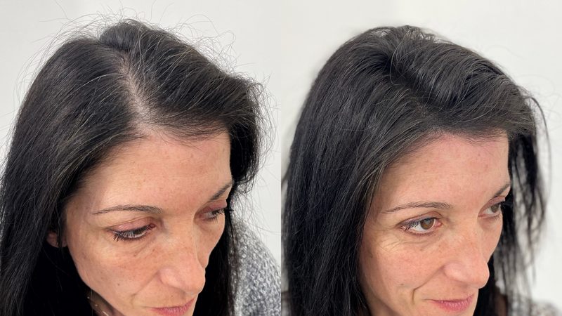 Tricopigmentazione Roma - Centro Dermamente Ennio Orsini