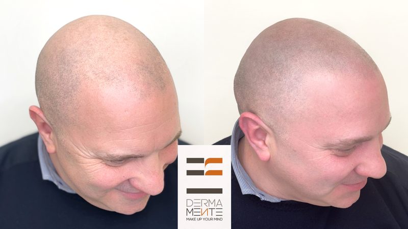 Tricopigmentazione stempiatura Roma