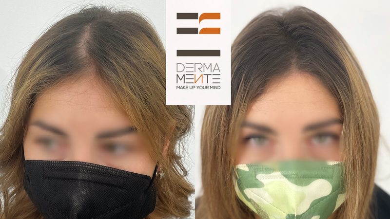 Tricopigmentazione uomo Roma