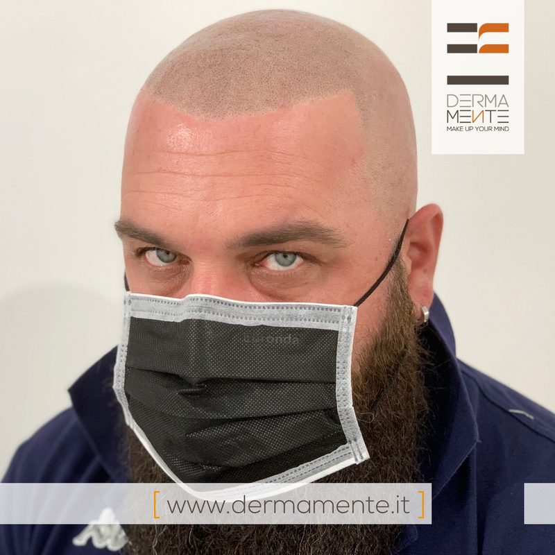 Tricopigmentazione uomo Roma