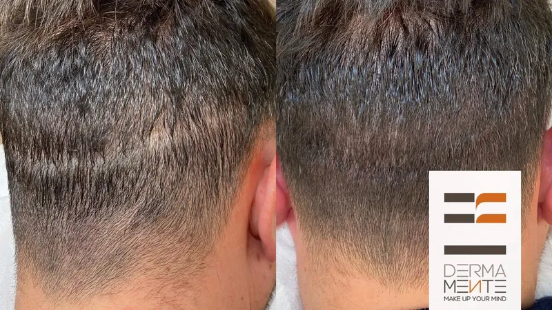 Tricopigmentazione uomo Roma - micropigmentazione capelli risultato naturale